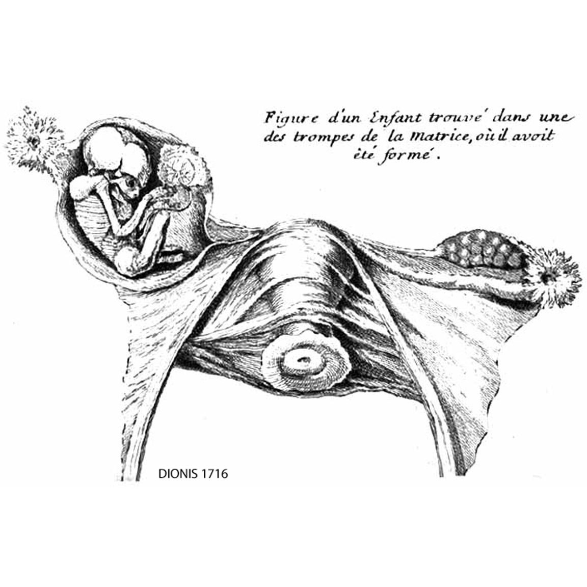 1716 DIONIS: right tubal ectopic
