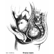 1842-CHURCHILL-Ovarian Tumor obstructing pelvis