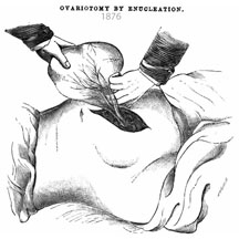 1876-Removal of large ovarian cyst