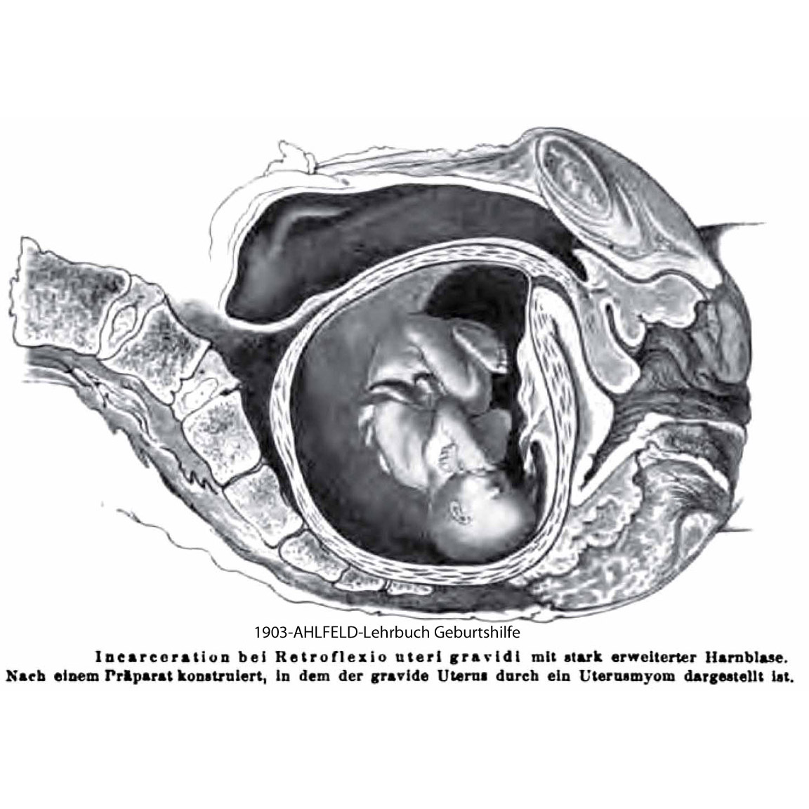 1903-AHLFELD-incarceration 
                of the RV uterus in early pregnancy