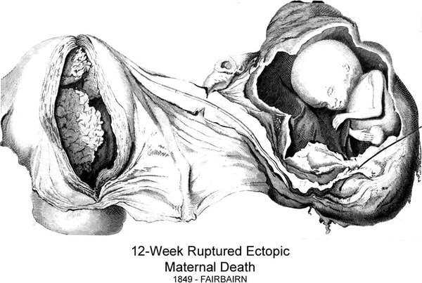 12-Wk Ruptured Ectopic
1842