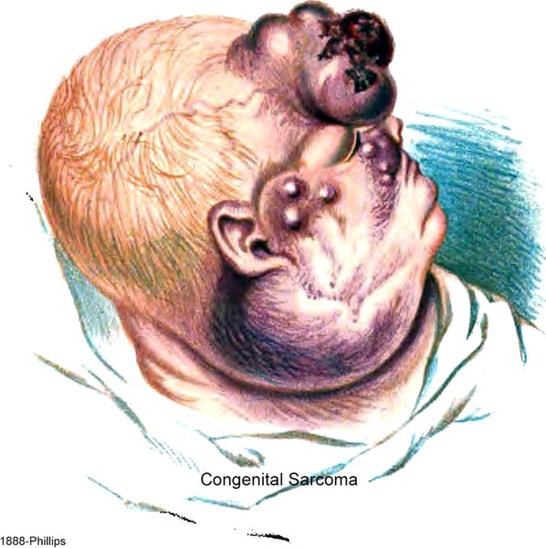 Congenital Sarcoma