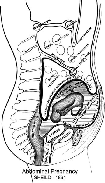 Abdominal Pregnancy
1891
