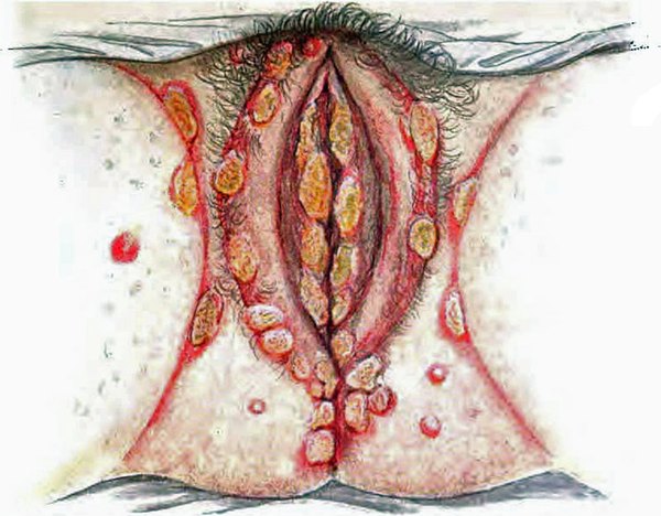 Extensive herpes lesions of vulva and perineumPicture