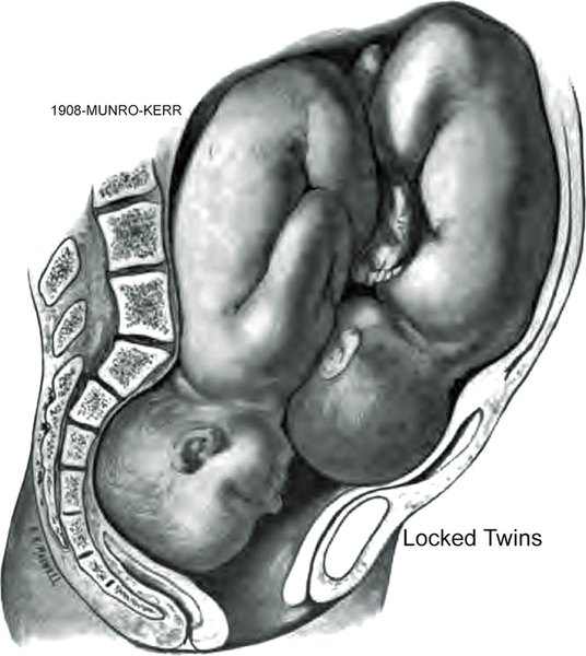 Locked Twins
