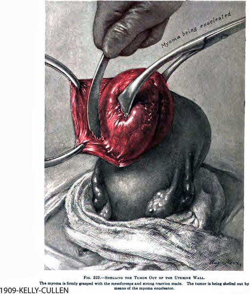 Myomectomy
