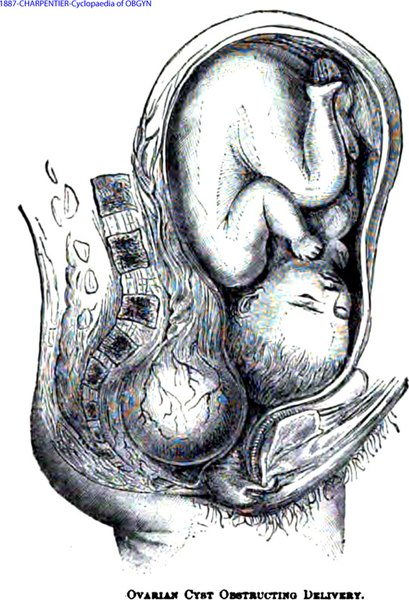 Dystocia
