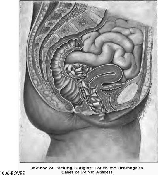 Vaginal-Non Prolapse