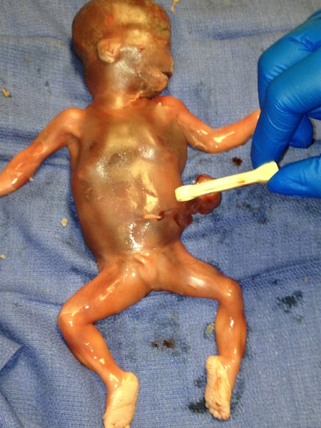 Prematurity