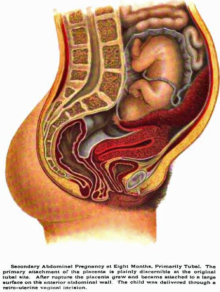 Abnormal Pregnancy