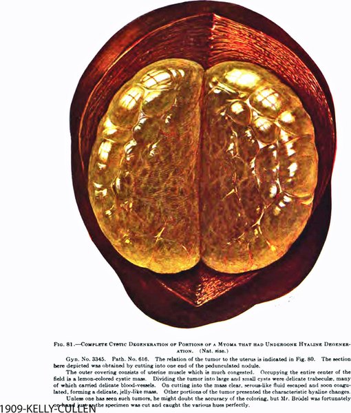 Fibroids (Leiomyomata)