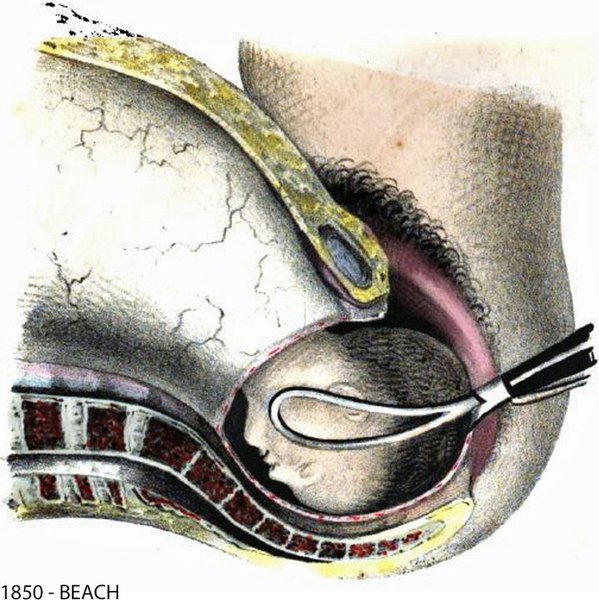 Forceps