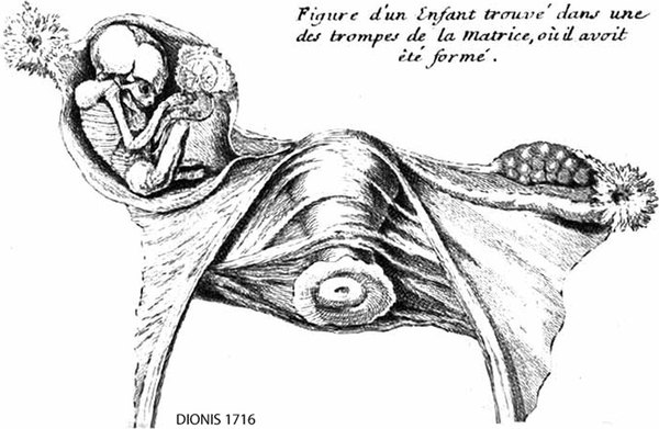 Ectopic Pregnancy