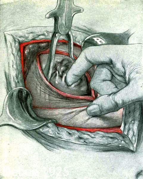 Cesarean Section