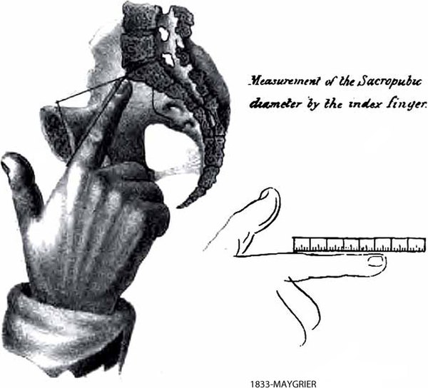 Pelvimetry