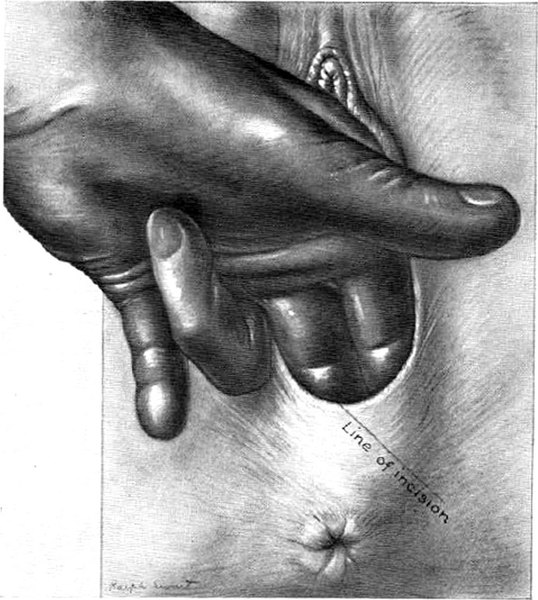 Episiotomy