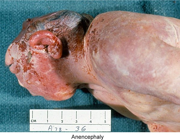 Anencephaly