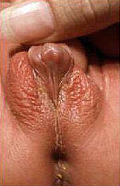 Congenital adrenal hyperplasia showing masculinization of female genitalia.