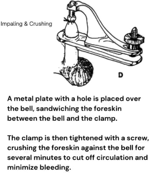 Gomco clamp – how it works