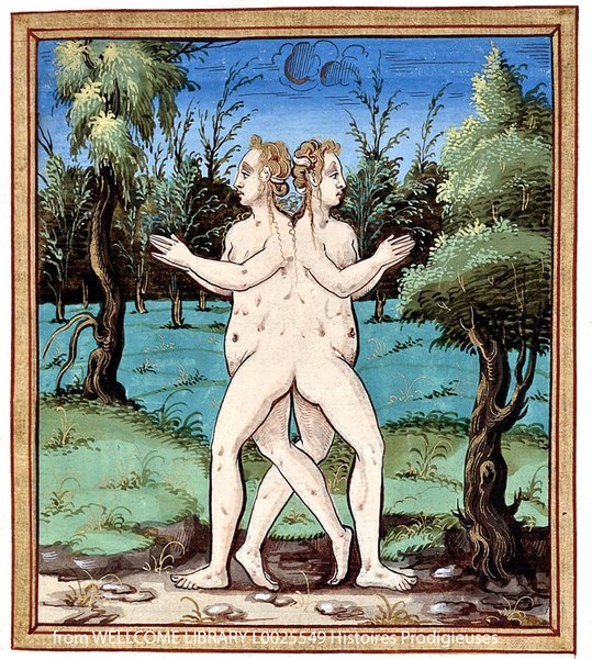 Conjoined Twins