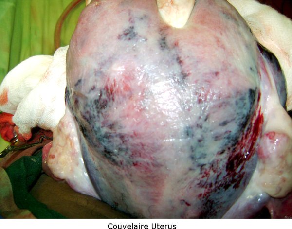 Abruption