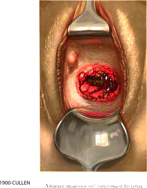 Speculum view of cervical squamous cell carcinoma
