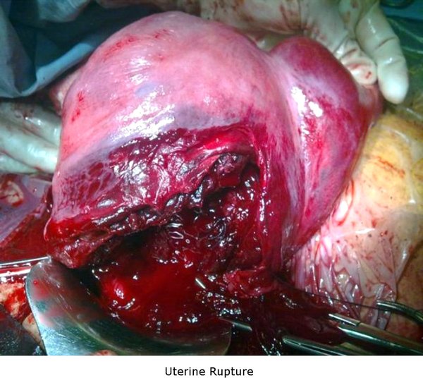 Uterine Rupture